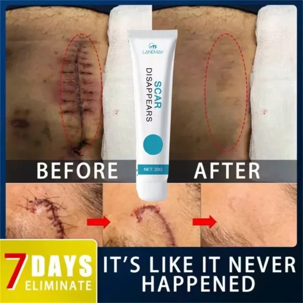 Scar Removal Cream Keloid Burn Surgical Scar Remove Treatment Stretch Marks Smoothing Whitening Pigmentation Body Care Ointment - Image 6