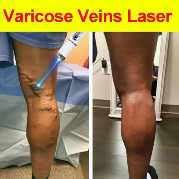 Laser Treatment for Varicose Veins Spider Legs Phlebitis Vasculitis Relieve Leg Pain Improve Blood Circulation - Image 4