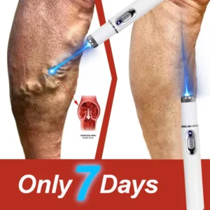 Laser Treatment for Varicose Veins Spider Legs Phlebitis Vasculitis Relieve Leg Pain Improve Blood Circulation