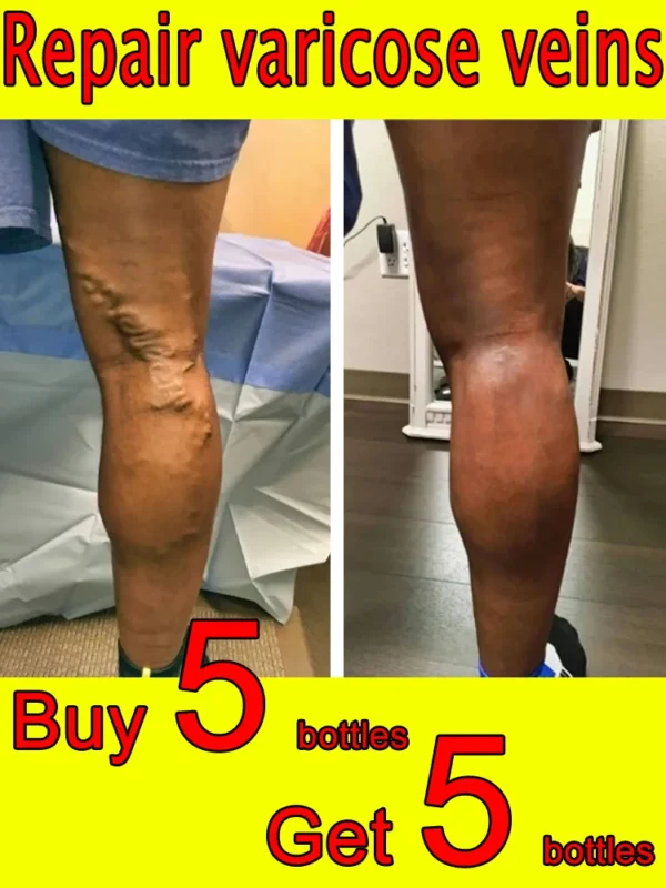 Laser Treatment for Varicose Veins Spider Legs Phlebitis Vasculitis Relieve Leg Pain Improve Blood Circulation - Image 2